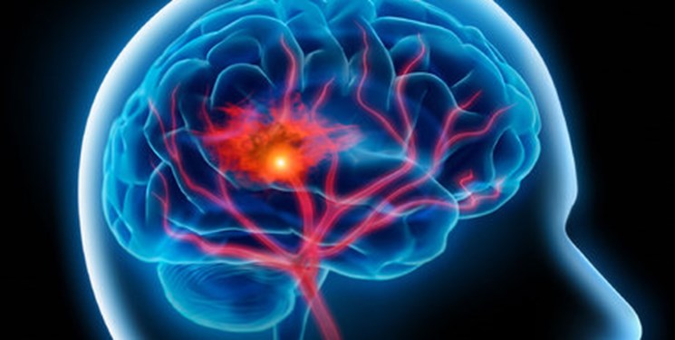 هشدار دانشمندان نسبت به سکته مغزی بیماران کرونا